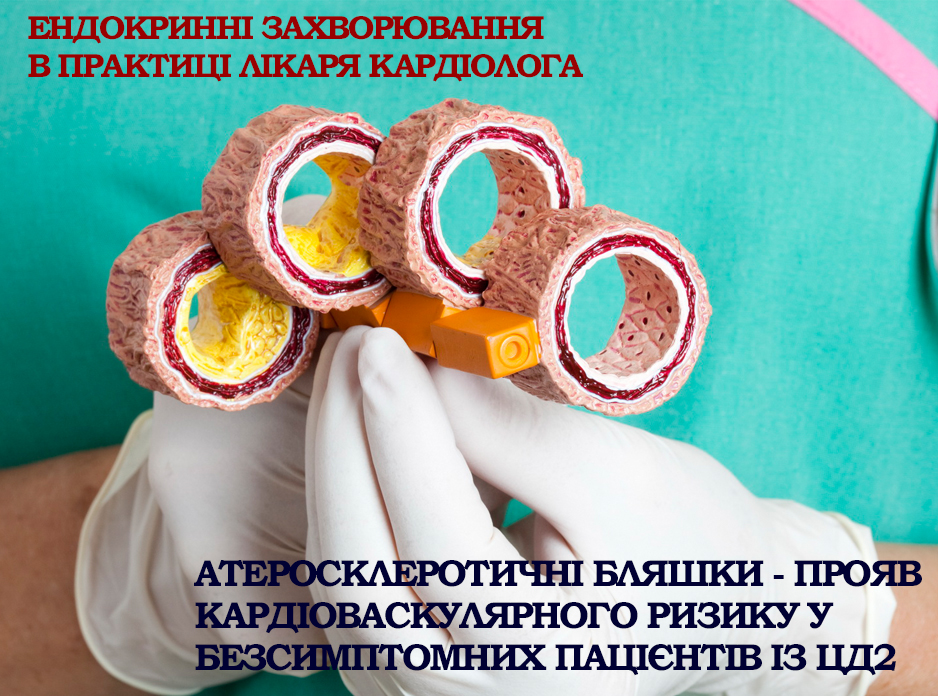 Атеросклеротические бляшки - проявление кардиоваскулярного риска у бессимптомных пациентов с сахарным диабетом 2